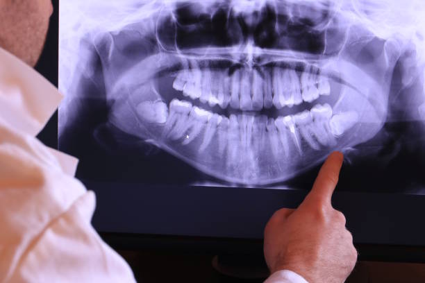 Best Emergency Wisdom Tooth Extraction in St Ignace, MI